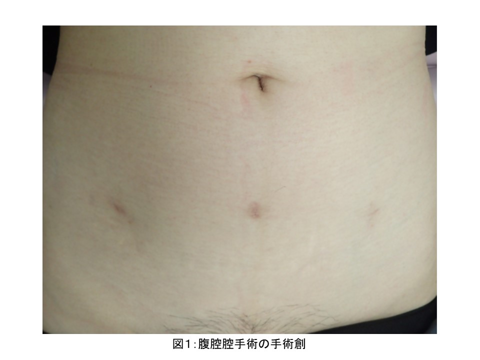 卵巣がんの症状は何ですか?